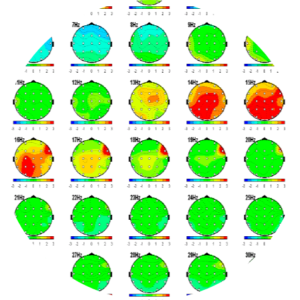 Brain-maps-QEEG-images-showing-how-neurofeedback-works-at-maxwell-clinic-in-nashville