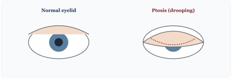 Diagram comparing a normal eyelid with a drooping eyelid, called ptosis